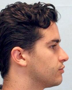 After Results for Rhinoplasty