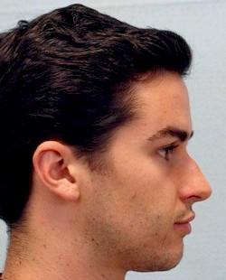 Before Results for Rhinoplasty