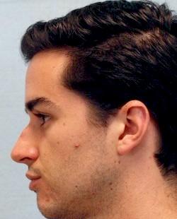 Before Results for Rhinoplasty