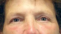 After Results for Blepharoplasty