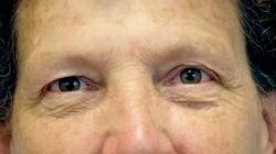 Before Results for Blepharoplasty