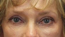 After Results for Blepharoplasty