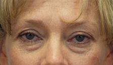 Before Results for Blepharoplasty