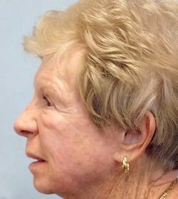 After Results for Laser Skin Resurfacing