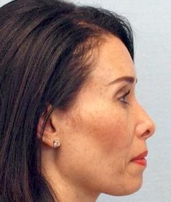 After Results for Rhinoplasty