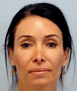 Before Results for Rhinoplasty