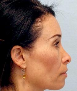 Before Results for Rhinoplasty