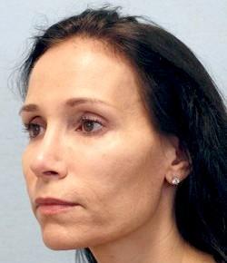 After Results for Rhinoplasty