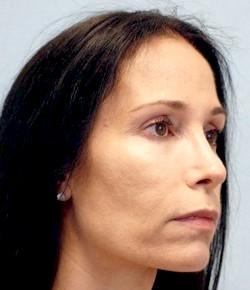 Before Results for Rhinoplasty