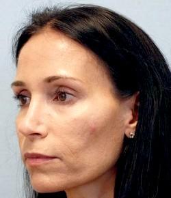 Before Results for Rhinoplasty