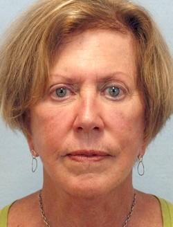 After Results for Facelift