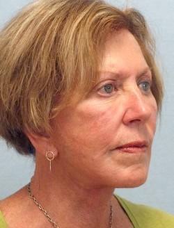 After Results for Facelift