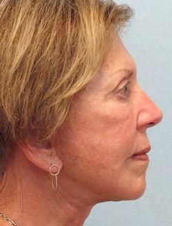 After Results for Necklift