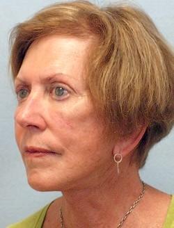 After Results for Facelift