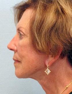 After Results for Facelift, Fat Transfer, Necklift