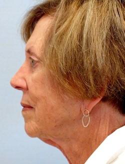 Before Results for Facelift