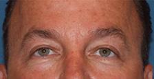 After Results for Blepharoplasty