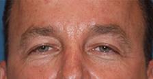 Before Results for Blepharoplasty