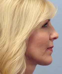 After Results for Facelift, Laser Skin Resurfacing, Fat Transfer, Necklift