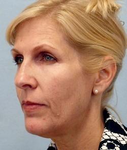 Before Results for Facelift