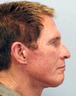 After Results for Necklift