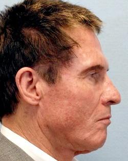 Before Results for Facelift, Fat Transfer, Necklift