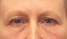 After Results for Blepharoplasty, Fat Transfer