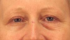 Before Results for Blepharoplasty