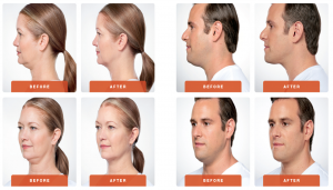 Kybella results - Having trouble seeing this? Please contact our office for details