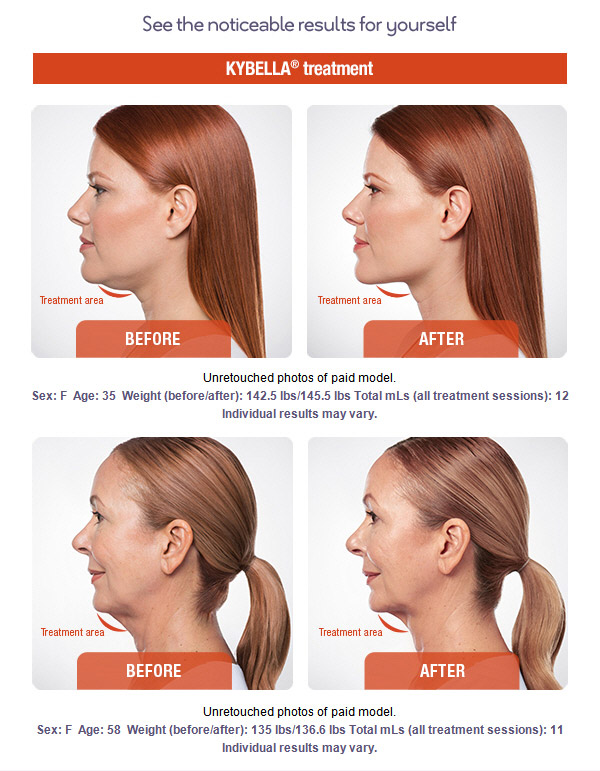 Kybella Results