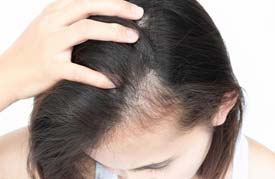 Photo of hair loss